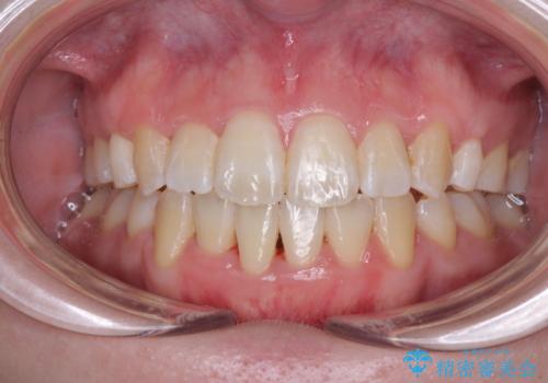 上下非接触で突出した前歯　ワイヤー装置による抜歯矯正