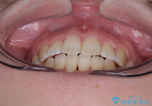 上下非接触で突出した前歯 ワイヤー装置による抜歯矯正の治療後