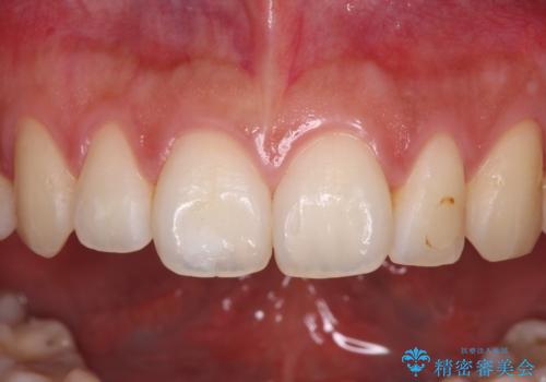 鼻の下を押すと痛い 前歯の根管治療とオールセラミッククラウンの治療前