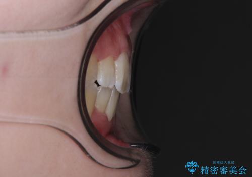 上下非接触で突出した前歯　ワイヤー装置による抜歯矯正の治療後