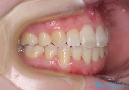 上下非接触で突出した前歯　ワイヤー装置による抜歯矯正の治療後