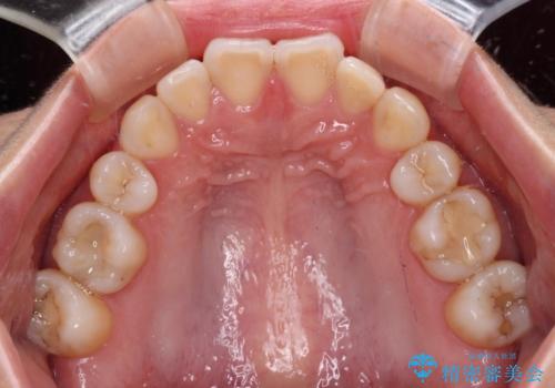鼻の下を押すと痛い 前歯の根管治療とオールセラミッククラウンの治療前