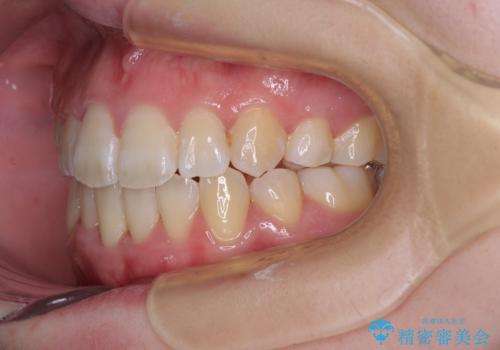 上下非接触で突出した前歯 ワイヤー装置による抜歯矯正の治療後