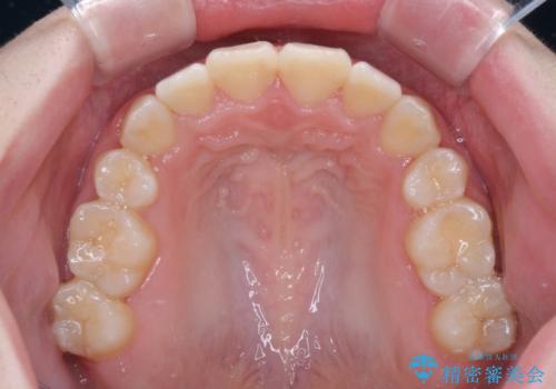 上下非接触で突出した前歯 ワイヤー装置による抜歯矯正の治療後