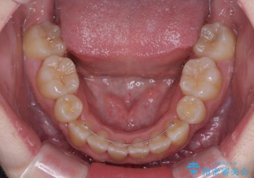 上下非接触で突出した前歯 ワイヤー装置による抜歯矯正の治療後