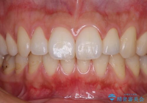 鼻の下を押すと痛い 前歯の根管治療とオールセラミッククラウンの治療後
