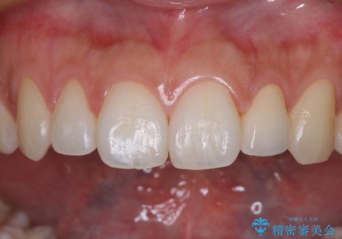 鼻の下を押すと痛い 前歯の根管治療とオールセラミッククラウンの治療後