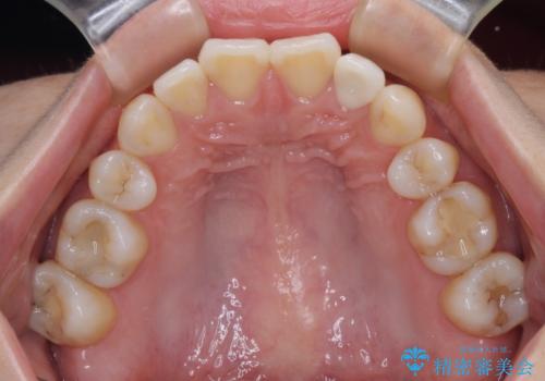 鼻の下を押すと痛い 前歯の根管治療とオールセラミッククラウンの治療後