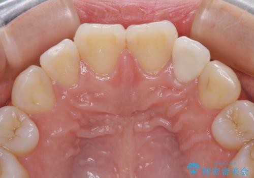 鼻の下を押すと痛い 前歯の根管治療とオールセラミッククラウンの治療後