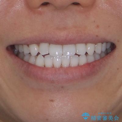 前歯のクロスバイトを改善　インビザラインによる矯正治療の治療後（顔貌）