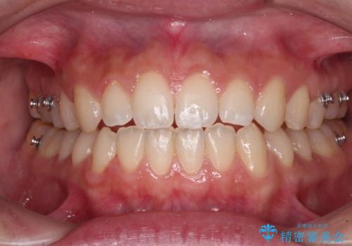 【モニター】隙間だらけの前歯を治したい インビザラインによる矯正治療の治療中