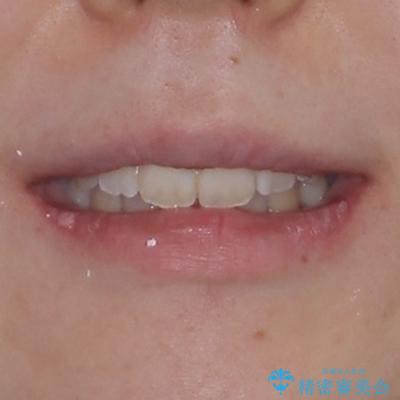 上下非接触で突出した前歯　ワイヤー装置による抜歯矯正の治療後（顔貌）