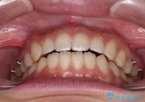 【モニター】隙間だらけの前歯を治したい インビザラインによる矯正治療の治療中