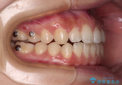 【モニター】隙間だらけの前歯を治したい インビザラインによる矯正治療の治療中