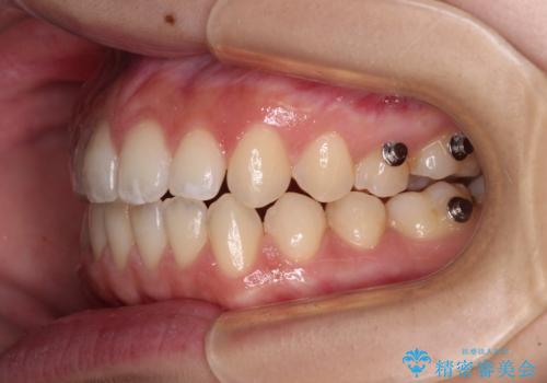 【モニター】隙間だらけの前歯を治したい インビザラインによる矯正治療の治療中