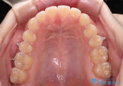 【モニター】隙間だらけの前歯を治したい インビザラインによる矯正治療の治療中