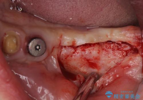 インプラントや歯周外科処置を用いた奥歯の補綴治療の治療前