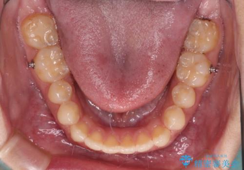 【モニター】隙間だらけの前歯を治したい インビザラインによる矯正治療の治療中