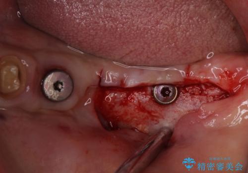 インプラントや歯周外科処置を用いた奥歯の補綴治療の治療中