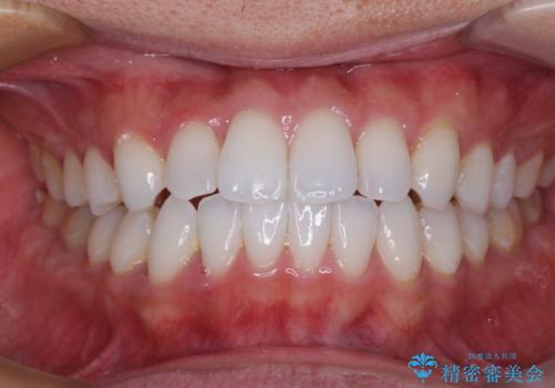 前歯のクロスバイトを改善　インビザラインによる矯正治療の症例 治療後