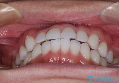 前歯のクロスバイトを改善 インビザラインによる矯正治療の治療後