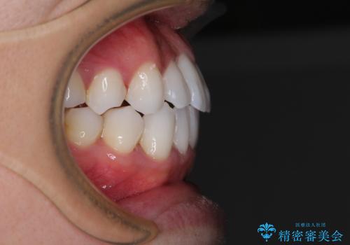 前歯のクロスバイトを改善 インビザラインによる矯正治療の治療後
