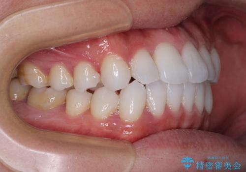 前歯のクロスバイトを改善 インビザラインによる矯正治療の治療後