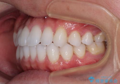前歯のクロスバイトを改善　インビザラインによる矯正治療の治療後