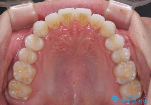 前歯のクロスバイトを改善 インビザラインによる矯正治療の治療後