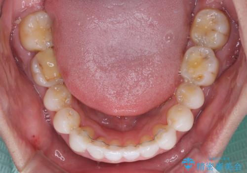 前歯のクロスバイトを改善 インビザラインによる矯正治療の治療後