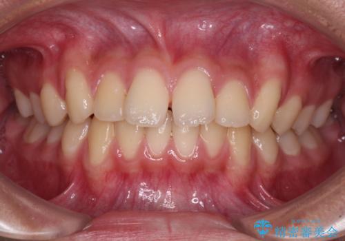 前歯の隙間とデコボコを改善　高校生のインビザライン治療の症例 治療前