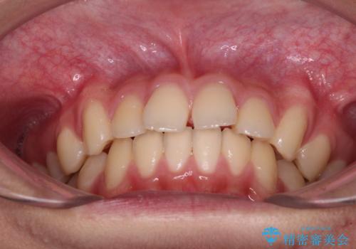 前歯の隙間とデコボコを改善 高校生のインビザライン治療の治療前