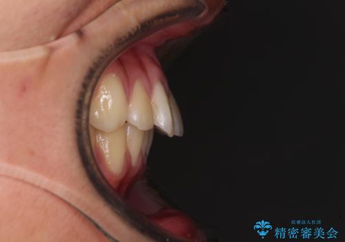 前歯の隙間とデコボコを改善 高校生のインビザライン治療の治療前