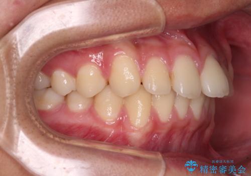 前歯の隙間とデコボコを改善 高校生のインビザライン治療の治療前