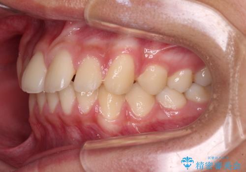 前歯の隙間とデコボコを改善　高校生のインビザライン治療の治療前