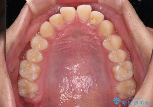 前歯の隙間とデコボコを改善 高校生のインビザライン治療の治療前