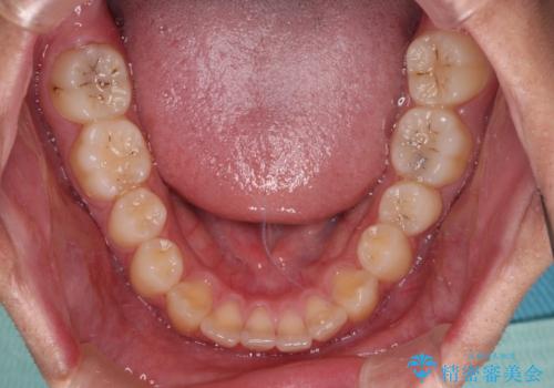 前歯の隙間とデコボコを改善 高校生のインビザライン治療の治療前