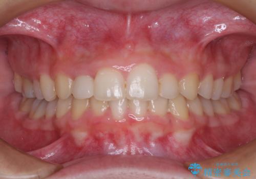 【モニター】前歯のデコボコと変色した前歯をインビザラインとオールセラミッククラウンでの治療後