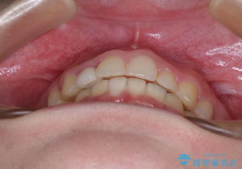 【モニター】前歯のデコボコと変色した前歯をインビザラインとオールセラミッククラウンでの治療後