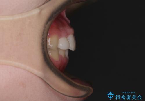 【モニター】前歯のデコボコと変色した前歯をインビザラインとオールセラミッククラウンでの治療後