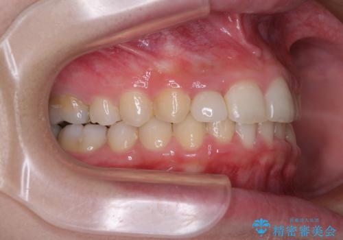 【モニター】前歯のデコボコと変色した前歯をインビザラインとオールセラミッククラウンでの治療後