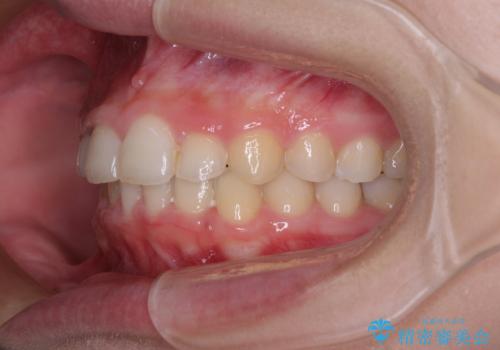 【モニター】前歯のデコボコと変色した前歯をインビザラインとオールセラミッククラウンでの治療後