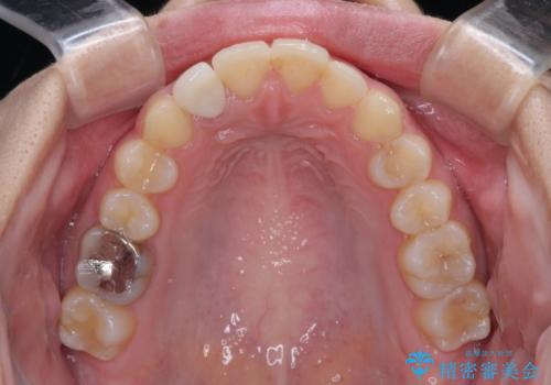 【モニター】前歯のデコボコと変色した前歯をインビザラインとオールセラミッククラウンでの治療後