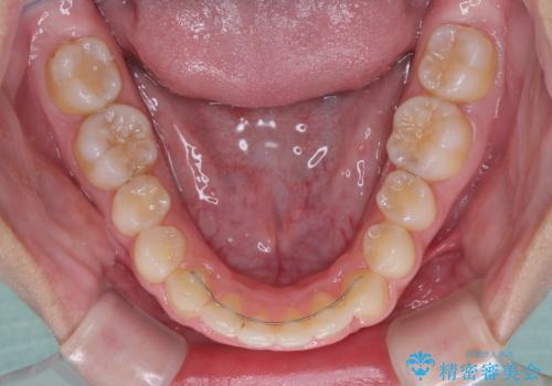 【モニター】前歯のデコボコと変色した前歯をインビザラインとオールセラミッククラウンでの治療後