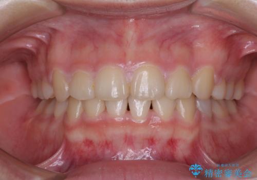 【モニター】治療途中で引っ越し ワイヤー装置を用いた抜歯矯正の治療後