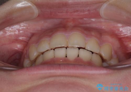 【モニター】治療途中で引っ越し ワイヤー装置を用いた抜歯矯正の治療後