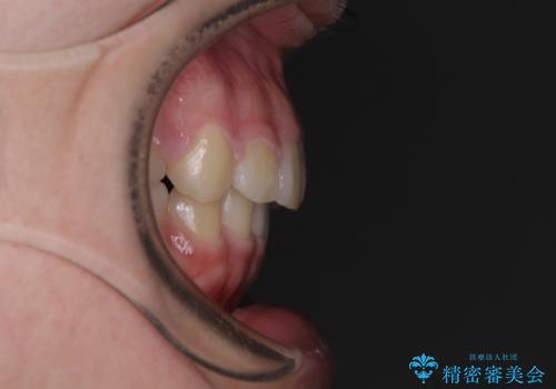 【モニター】治療途中で引っ越し ワイヤー装置を用いた抜歯矯正の治療後