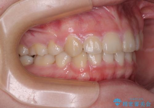 【モニター】治療途中で引っ越し ワイヤー装置を用いた抜歯矯正の治療後