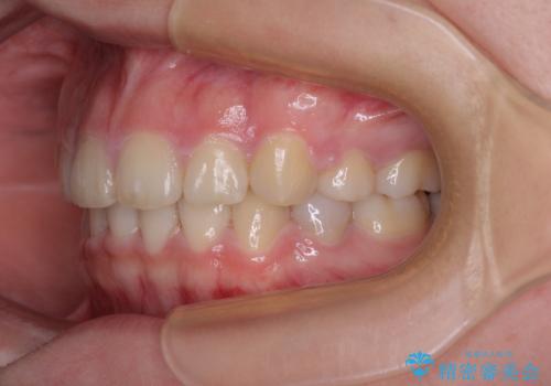 【モニター】治療途中で引っ越し ワイヤー装置を用いた抜歯矯正の治療後