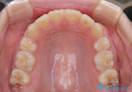 【モニター】治療途中で引っ越し ワイヤー装置を用いた抜歯矯正の治療後